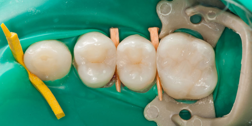  Кариес на контактных поверхностях зубов один из самых коварных