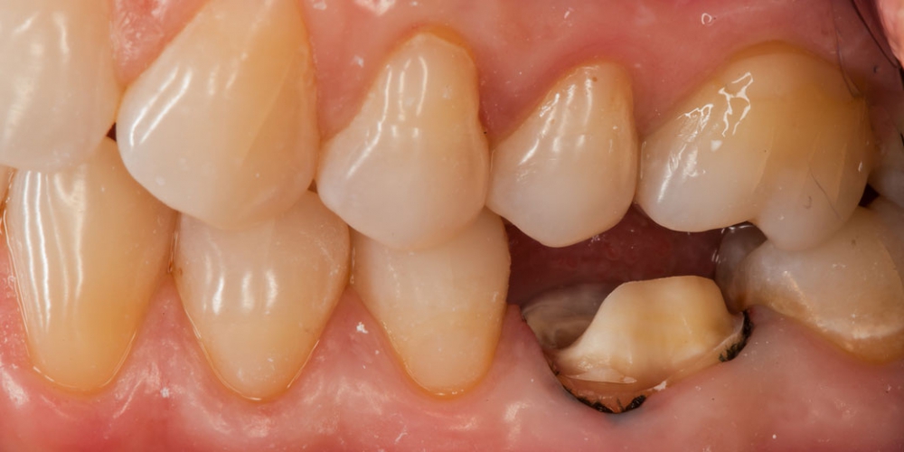 Наглядное фото без коронки зуба Восстановление зуба цельнокерамической коронкой смоделированной в 3D