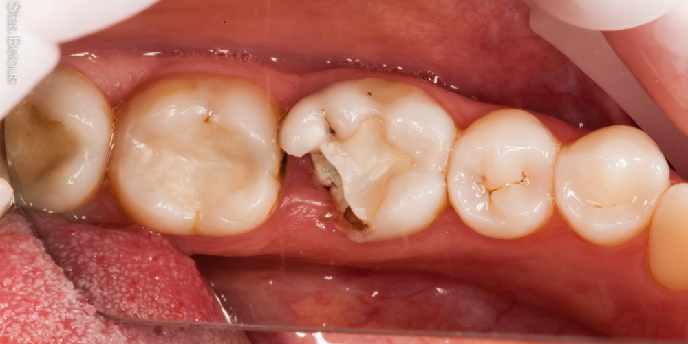  Восстановление отколотого зуба полукоронкой