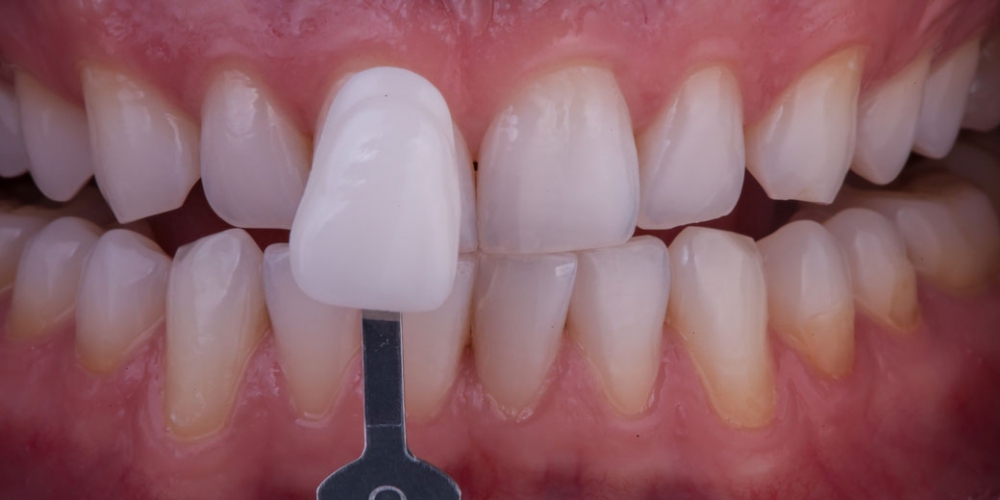Результат отбеливания зубов. Отбеливание зубов безопасно