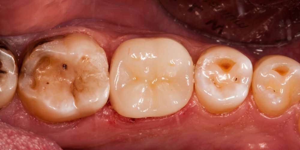 Фото после лечения и установки коронки Восстановление разрушенного зуба керамической полукоронкой