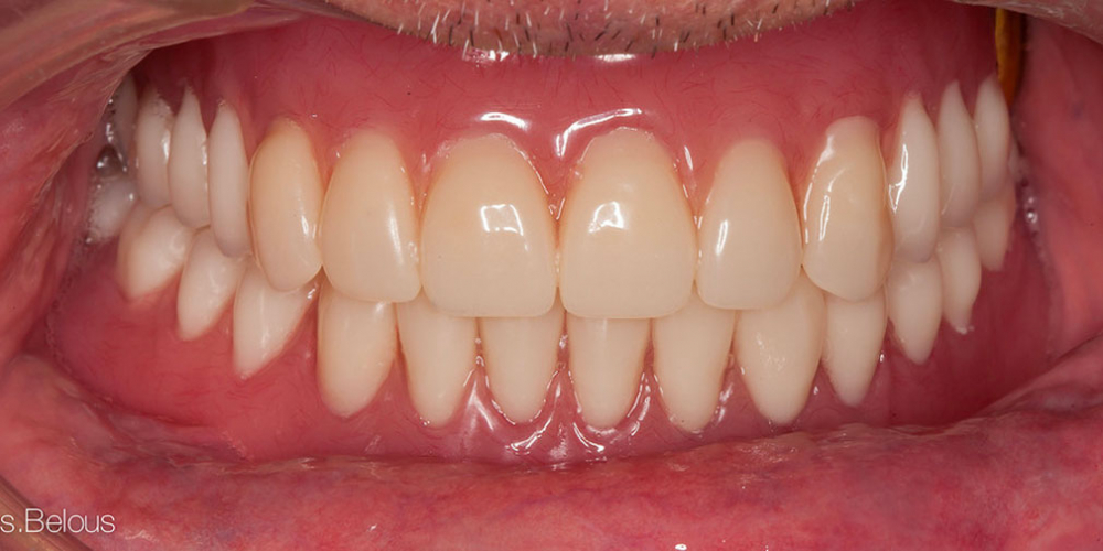 Восстановление прикуса полными съемными протезами при отсутствии всех зубов