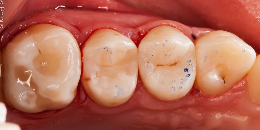 Фото после лечения кариеса. Скрытый кариес, лечение скрытых кариозных полостей на боковых поверхностях зубов