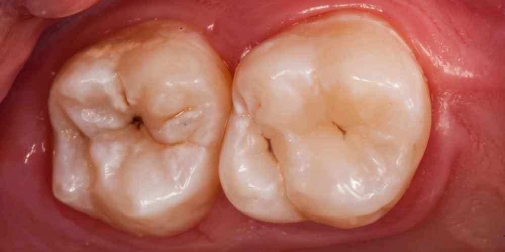 Фото после лечения и реставрации зуба. Результат лечения кариеса, реставрация жевательного зуба
