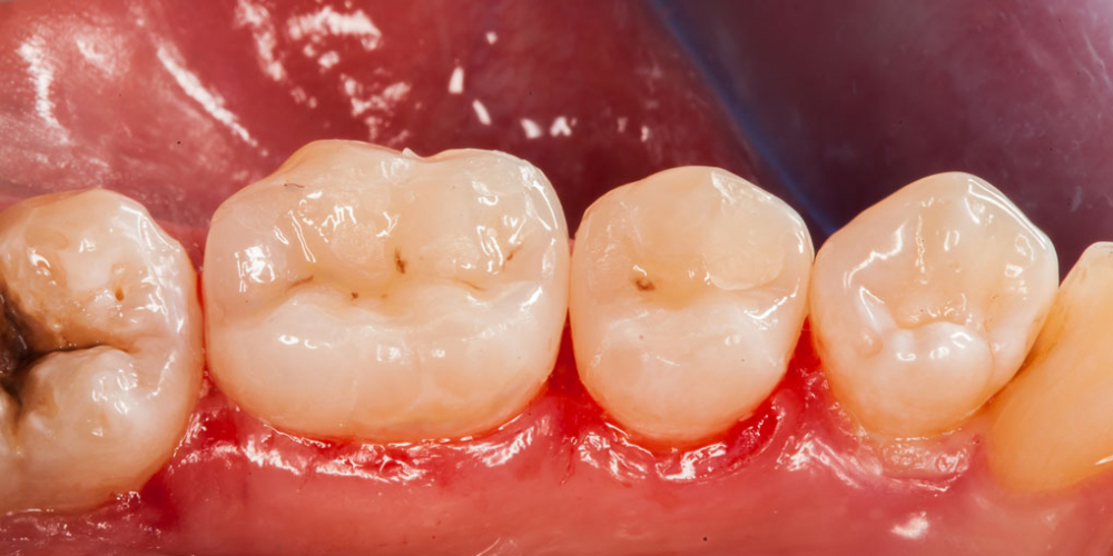  Начали лечение кариеса на одном зубе, а в итоге сделали - 2, цельнокерамическими вкладками