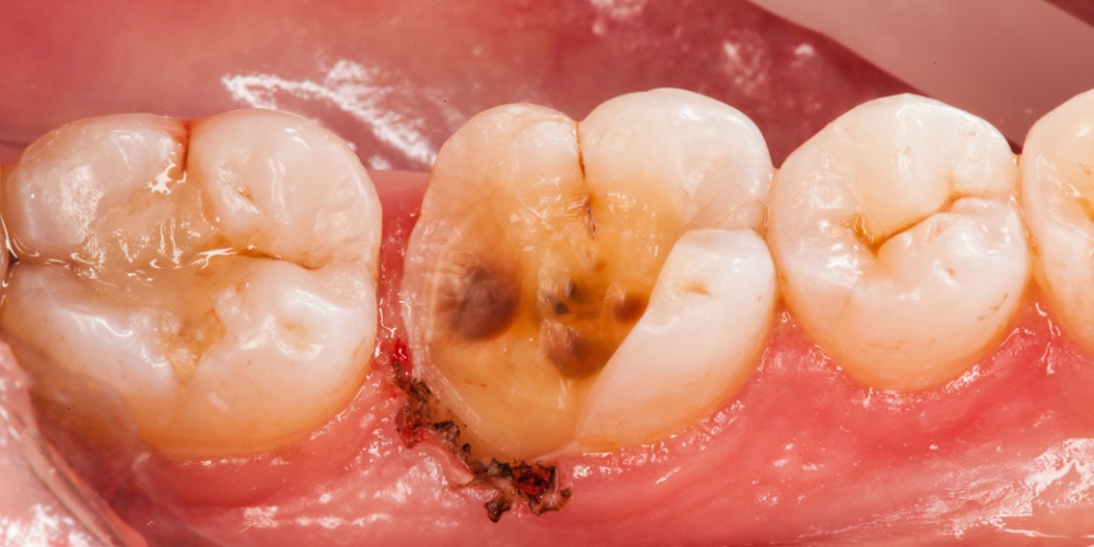 Фото до лечения Восстановление разрушенного зуба керамической вкладкой