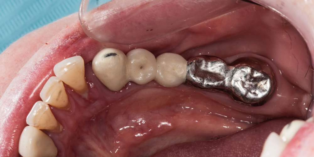  Протезирование зубов на имплантантах