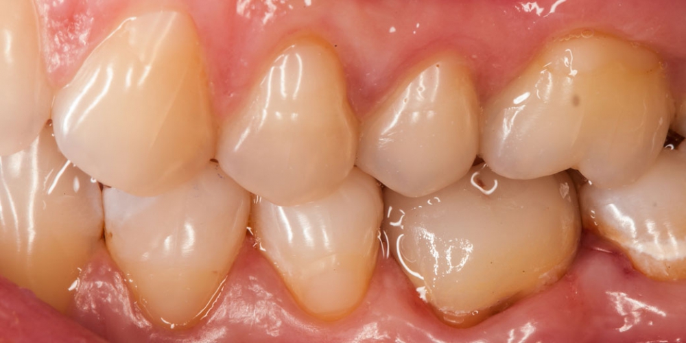 Наглядное фото с восстановленной коронкой зуба Восстановление зуба цельнокерамической коронкой смоделированной в 3D