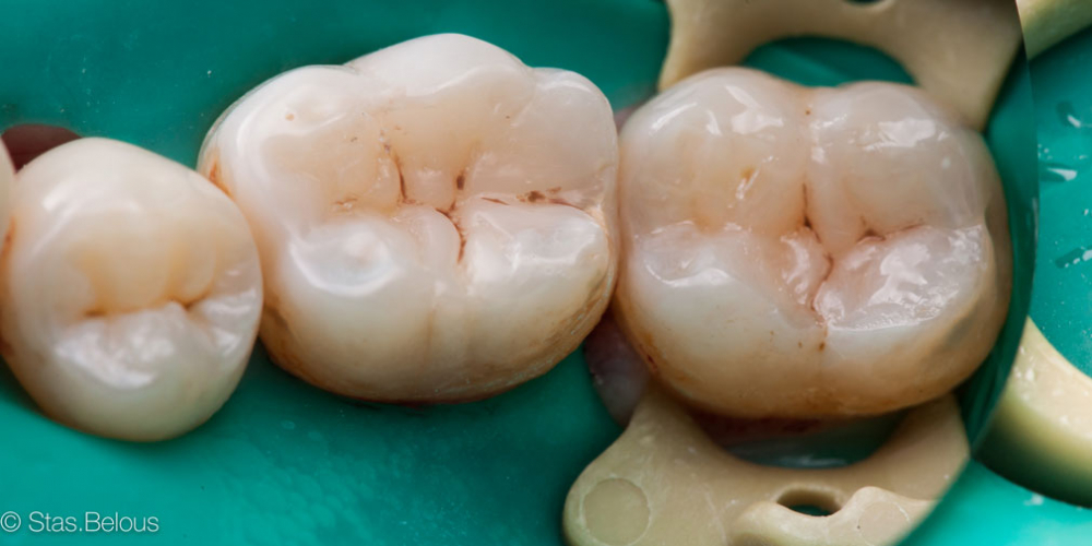  Лечение глубокого кариеса 36 и 37 зуба