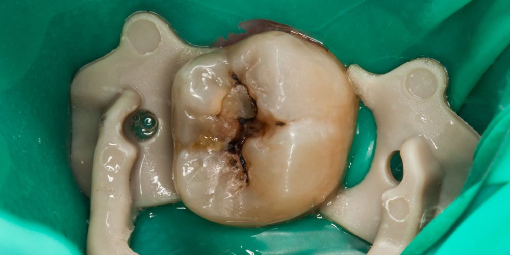  Результат лечения кариеса и реставрация жевательного зуба 38