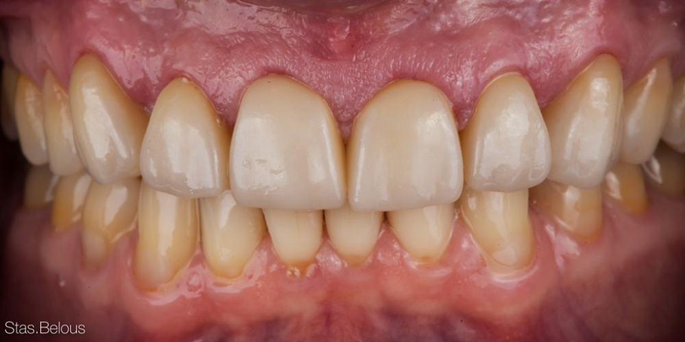  Полное воссоздание верхнего зубного ряда