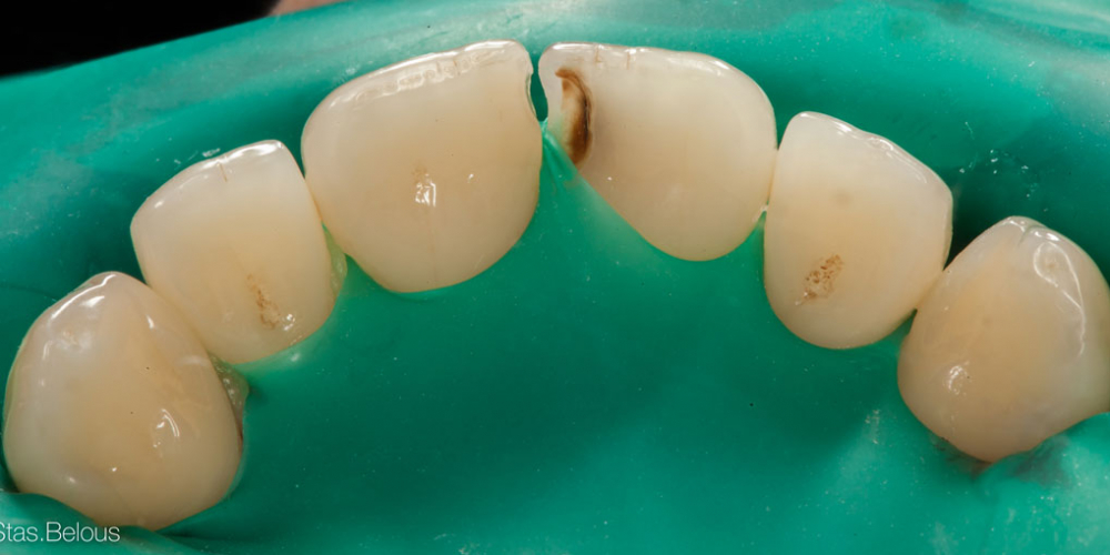  Лечение кариеса и реставрация скола на переднем зубе