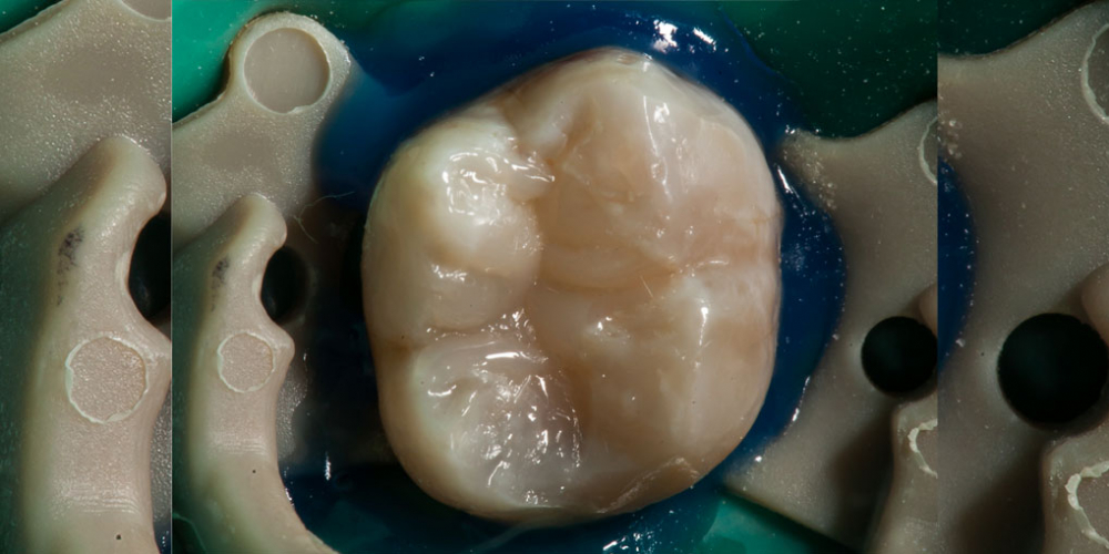  Результат лечения кариеса и реставрация жевательного зуба 38