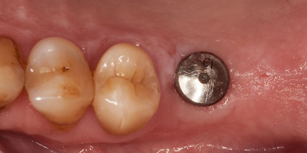 Пациенту был установлен дентальный имплант. Через 6 месяцев установлен стандартный формирователь десны. Протезирование зуба после имплантации