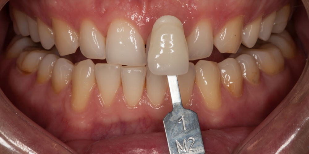 Фото до отбеливания зубов Отбеливание зубов безопасно