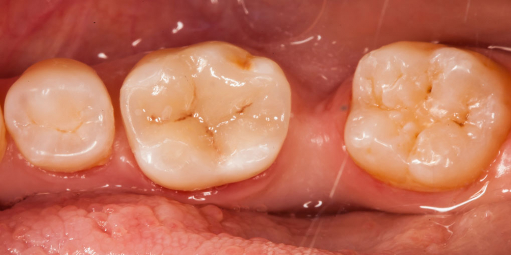  Цельнокерамическая реставрация жевательного зуба