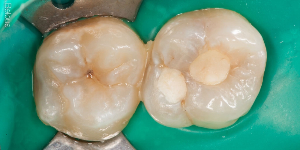 Фото до лечения зуба. Результат лечения кариеса, реставрация жевательного зуба