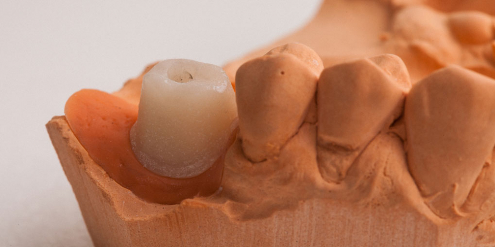 Затем установили переходную часть между имплантом и коронкой, которая называется индивидуальный абатмент. Протезирование зуба после имплантации