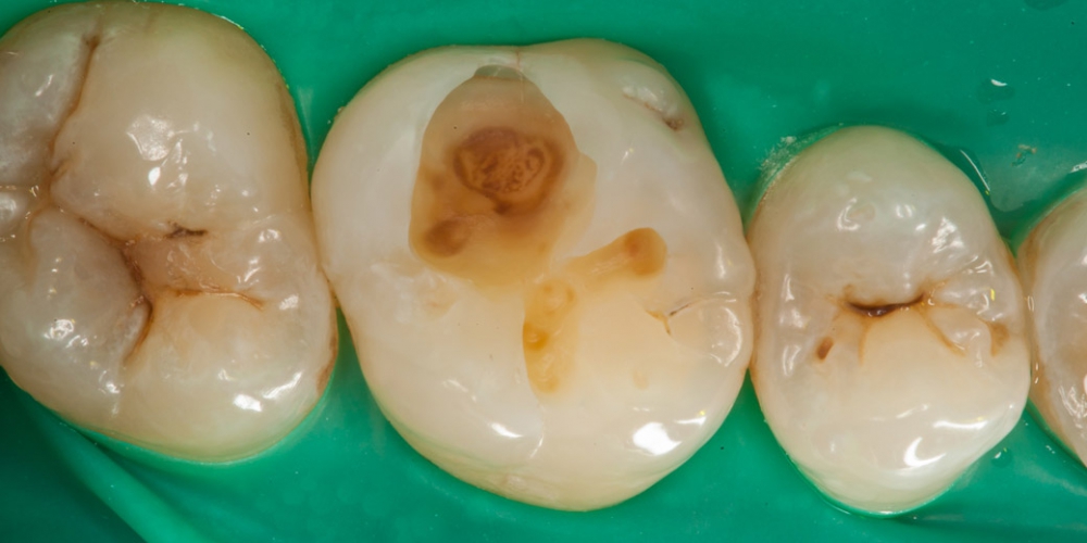 Протравливание ортофосфорной к-той, нанесение адгезивной системы Ivoclar Vivadent. Пломба или реставрация зуба