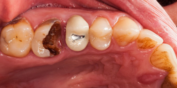 Восстановление зуба цельнокерамической коронкой фото до лечения