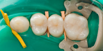 Кариес на контактных поверхностях зубов один из самых коварных фото после лечения