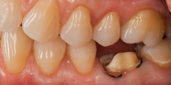 Восстановление зуба цельнокерамической коронкой смоделированной в 3D фото до лечения