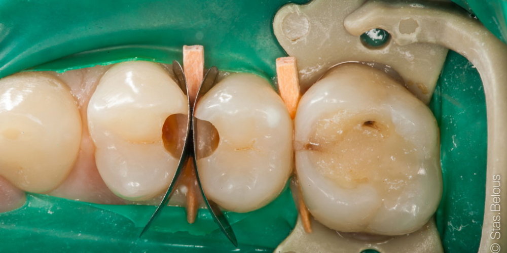  Кариес на контактных поверхностях зубов один из самых коварных