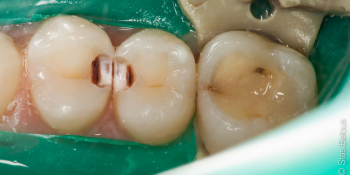 Кариес на контактных поверхностях зубов один из самых коварных фото до лечения