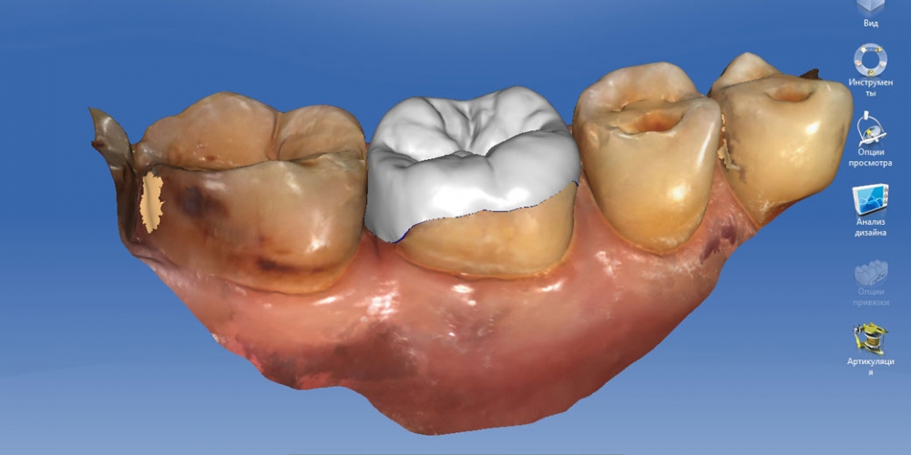 Компьютерное моделирование будущей коронки Восстановление разрушенного зуба керамической полукоронкой
