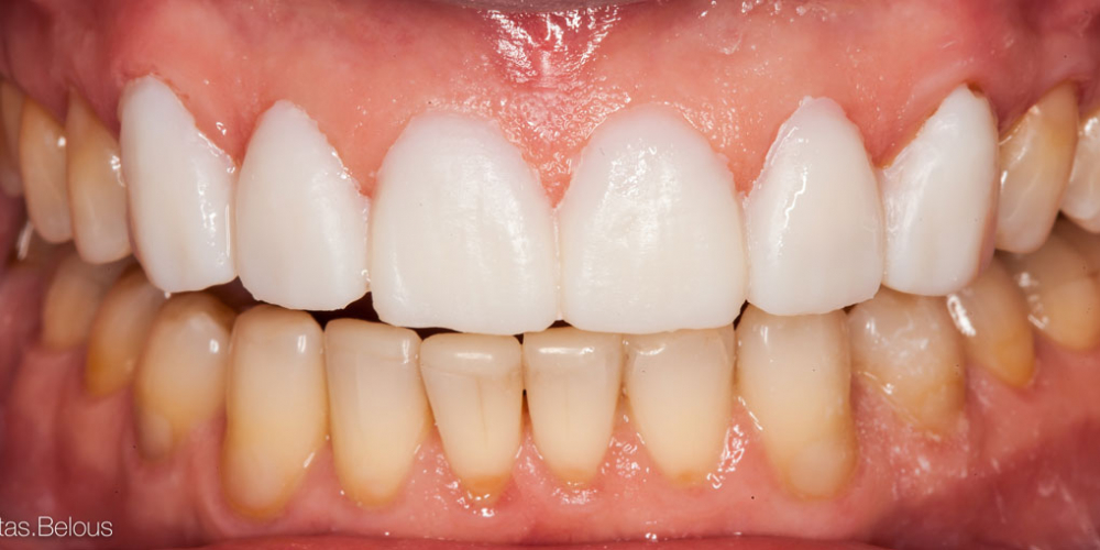Примерка будущих зубов. Полное воссоздание верхнего зубного ряда