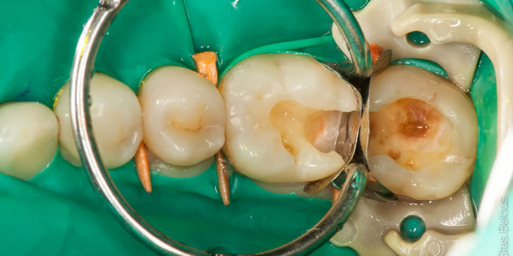  Жалоба на застревание пищи между зубами 36 и 37