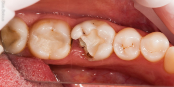 Восстановление отколотого зуба полукоронкой фото до лечения