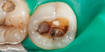 Выпадение старой пломбы из коренного зуба фото до лечения