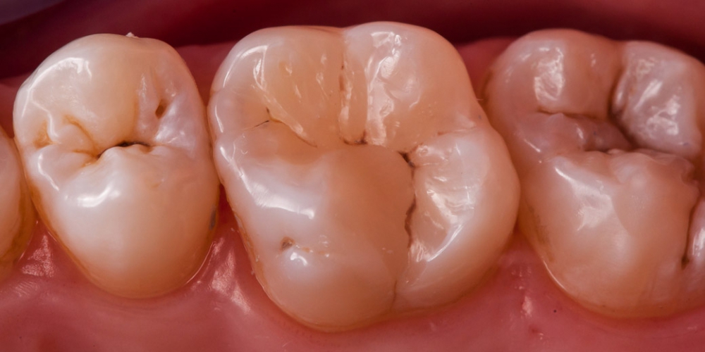 Новая композиционная реставрация выполнена из IPS empress Direct Ivoclar vivadent 
Dentine a3.5
Enamel A2, A1
Trans 30

Проведена индивидуализация реставрации красителями от ENAMEL HRI Brown2 Пломба или реставрация зуба