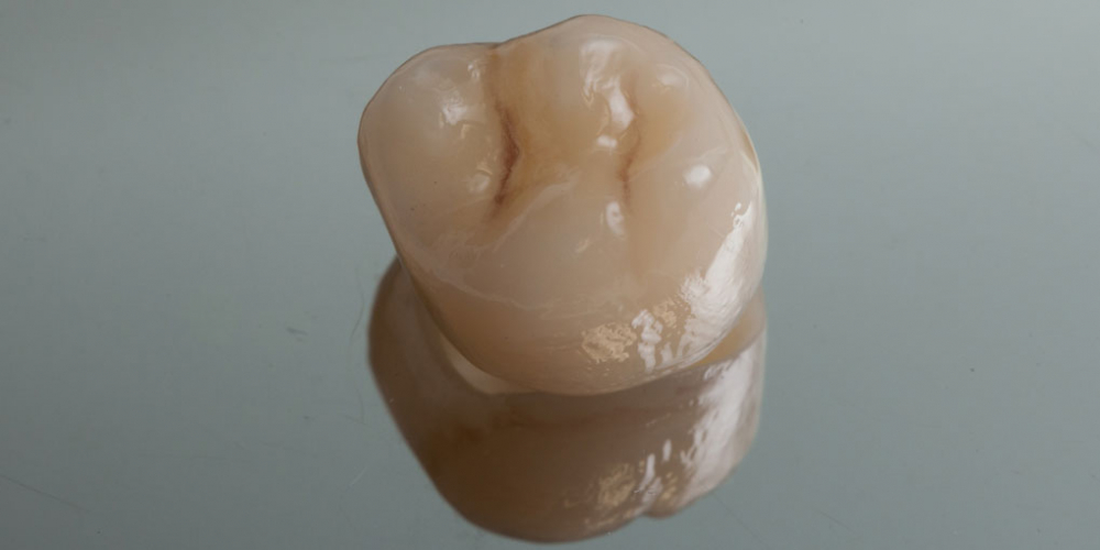 Цельнокерамическая коронка изготовлена на станке CEREC. Протезирование зуба после имплантации