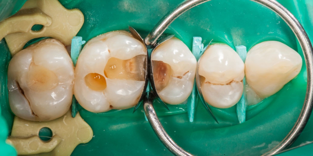 Формируем боковые стенки зубов Лечение кариеса (беспокоило застревание пищи между зубами)