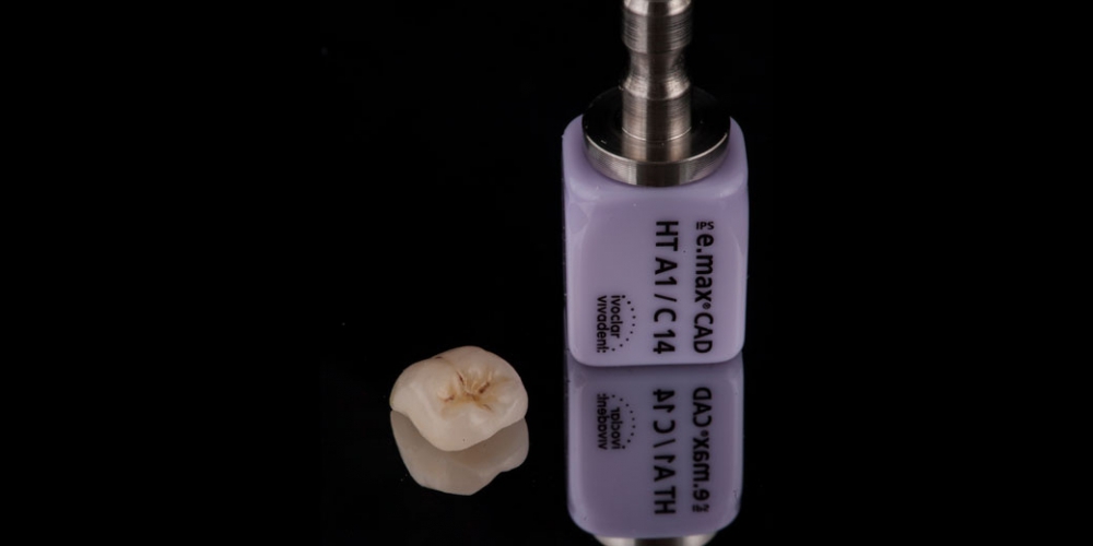 Смоделированная коронка Восстановление зуба цельнокерамической коронкой смоделированной в 3D