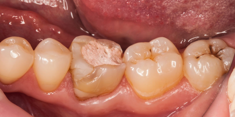 Исходная ситуация Восстановление зуба цельнокерамической коронкой смоделированной в 3D