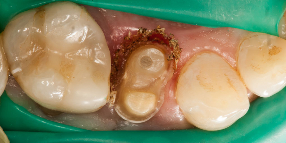  Скол депульпированного зуба (без нерва)