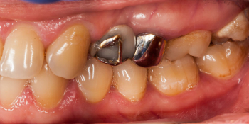 Установка мостовидного протеза из 3х единиц с опорой на 2 зуба фото до лечения