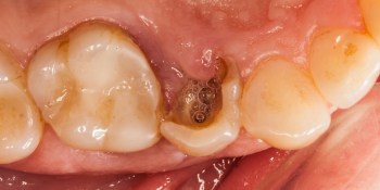 Скол депульпированного зуба (без нерва) фото до лечения