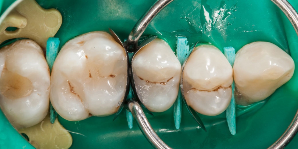 Завершение реставрации Лечение кариеса (беспокоило застревание пищи между зубами)