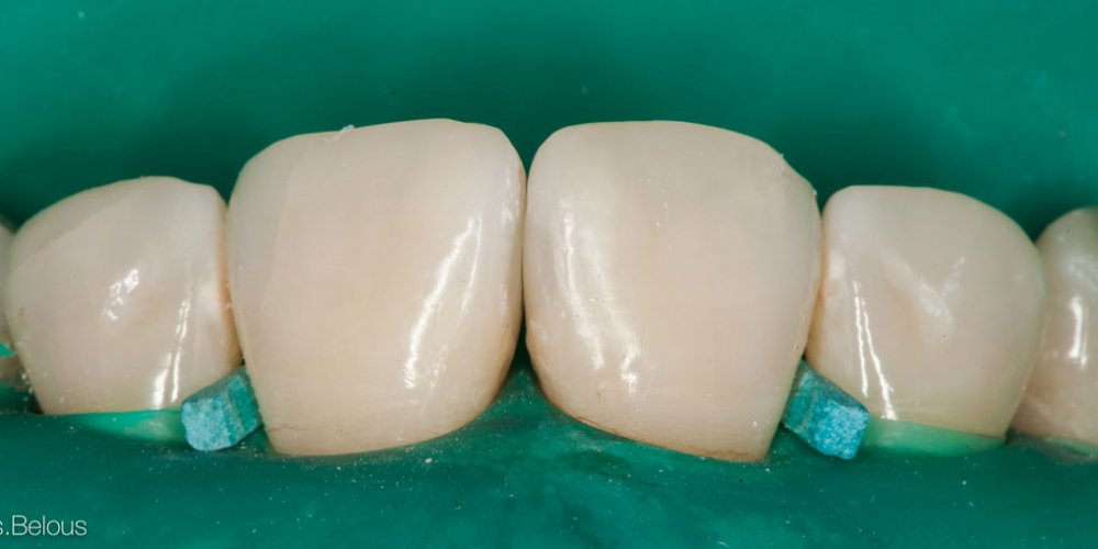  Лечение кариеса и реставрация передних зубов