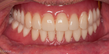 Восстановление прикуса полными съемными протезами при отсутствии всех зубов фото после лечения