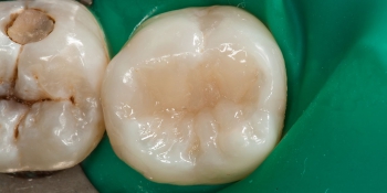 Выпадение старой пломбы из коренного зуба фото после лечения