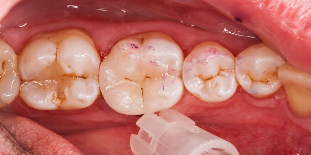 Проверка контактов Восстановление разрушенного зуба керамической вкладкой