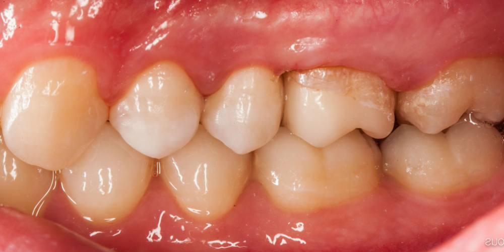  Выпадение пломбы из 26 зуба