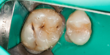 Лечение кариеса двух зубов в одно посещение фото до лечения