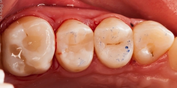 Скрытый кариес, лечение скрытых кариозных полостей на боковых поверхностях зубов фото после лечения
