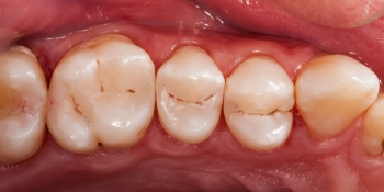 Лечение кариеса (беспокоило застревание пищи между зубами) фото после лечения